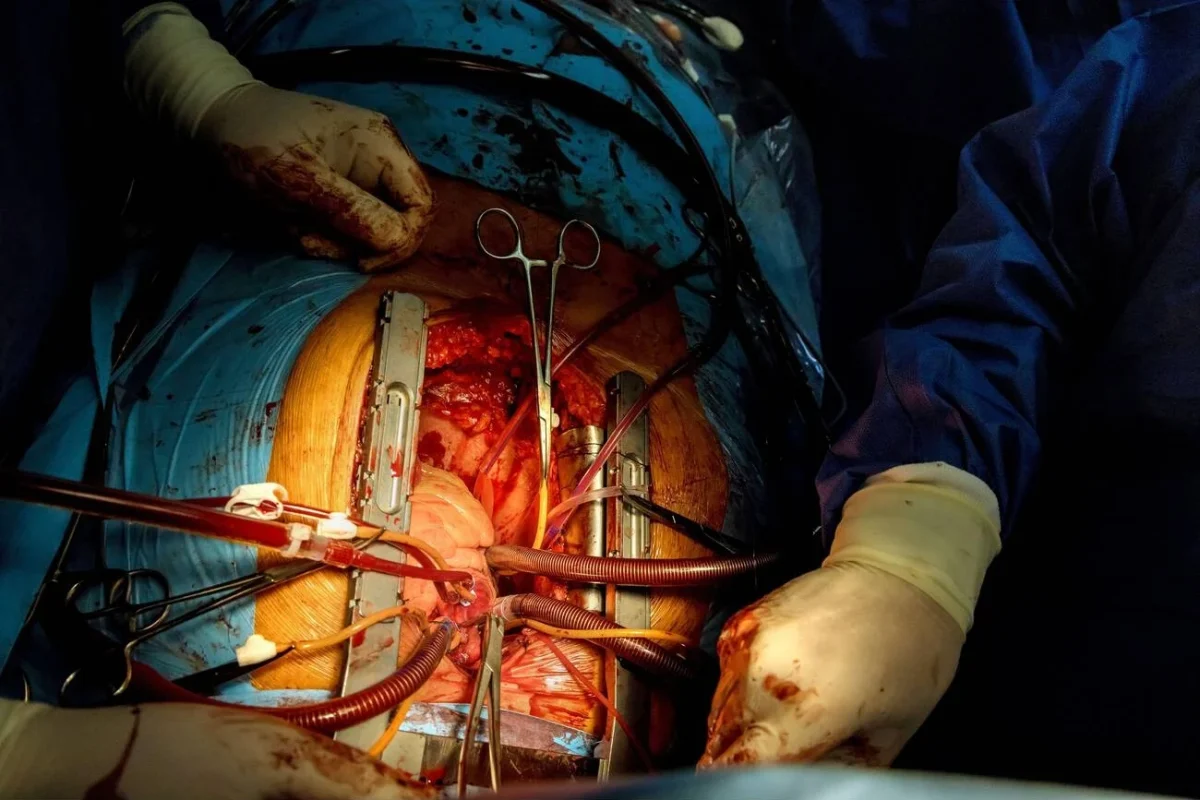 heart surgery in iran