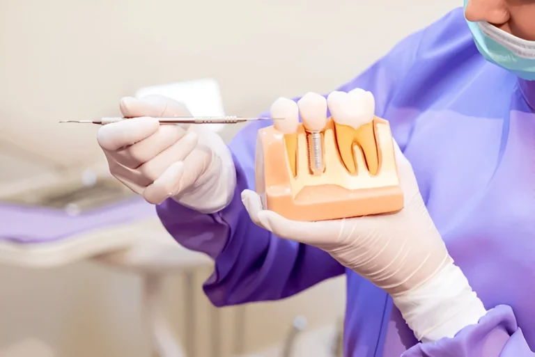 1. Dental Implants in Iran
