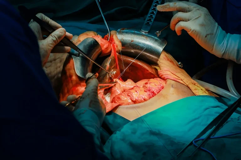 liver cost transplant in Iran